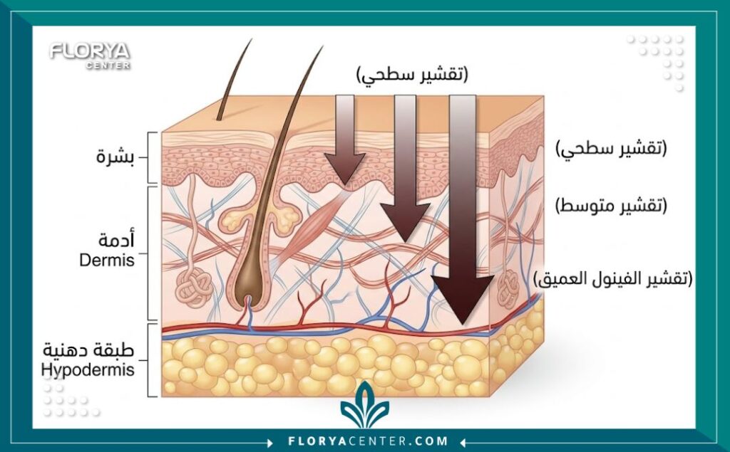 رسم تخطيطي طبي يوضح عمق اختراق التقشير بالفينول لطبقات الجلد العميقة لتحفيز الكولاجين وعلاج التجاعيد المستعصية.