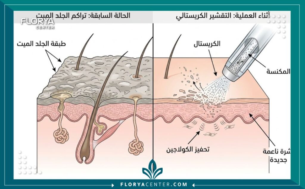 رسم تخطيطي طبي يوضح كيفية عمل التقشير الكريستالي في إزالة طبقات الجلد الميت.