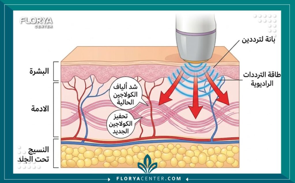 رسم تخطيطي طبي يوضح كيفية عمل تقنية الثيرماج في اختراق طبقات الجلد لتحفيز الكولاجين وشد البشرة بالترددات الراديوية.