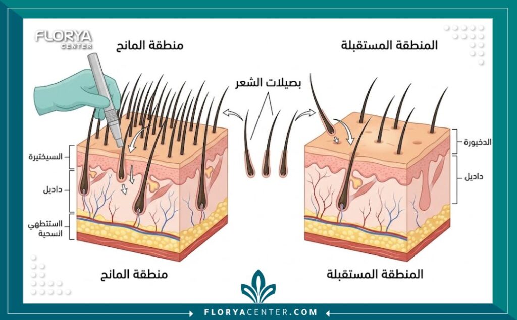 رسم تخطيطي طبي يوضح عملية اقتطاف البصيلات (FUE) لزراعة الشعر في فروة الرأس.
