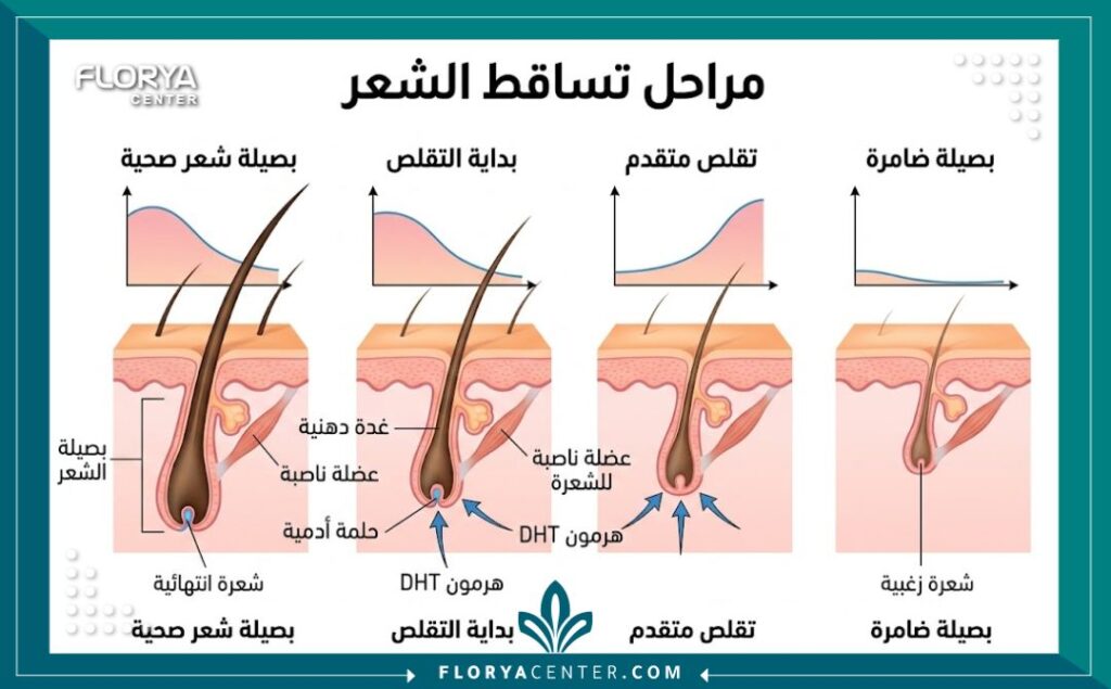 إنفوجرافيك يوضح أسباب تساقط الشعر عند الرجال وأحدث طرق العلاج والتقنيات المستخدمة الصلع لدى الرجال .. أسبابه وعلاجه.