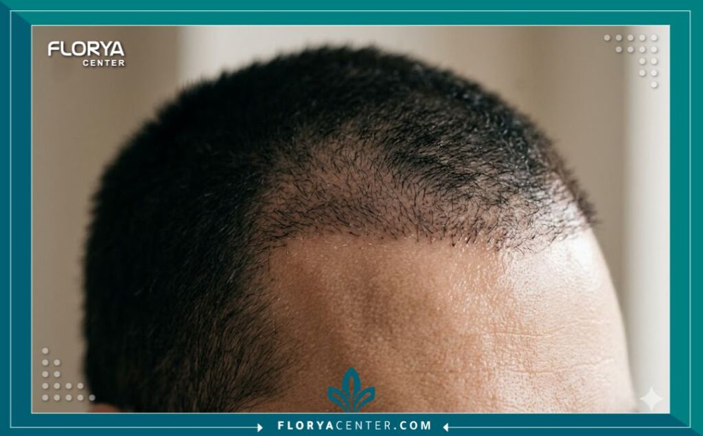 لقطة قريبة توضح كثافة الشعر عند خط الجبهة بعد الخضوع لعلاجات إنبات الشعر.