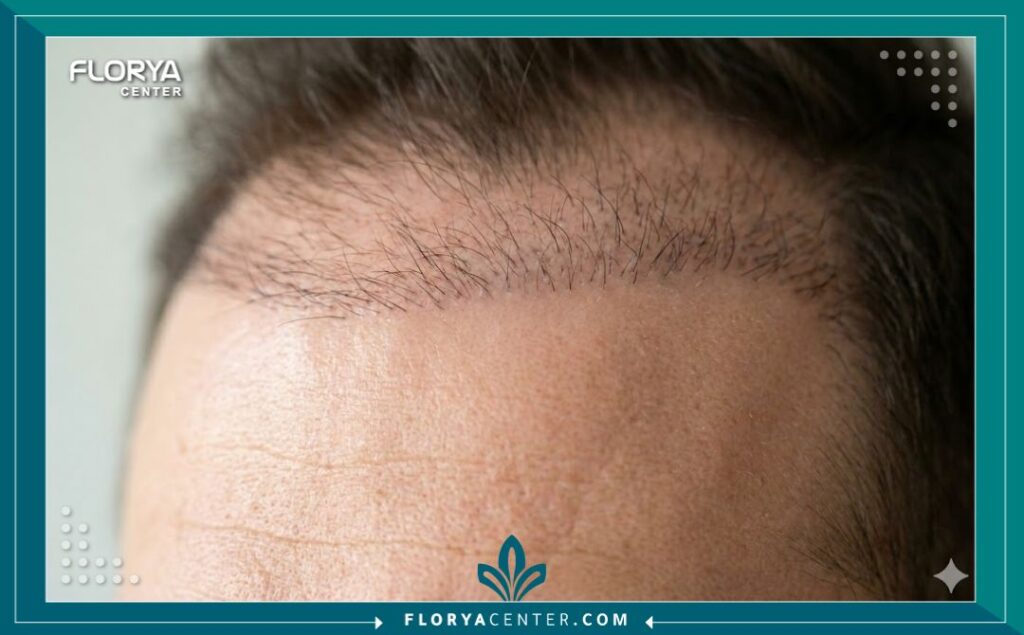 صورة قريبة (ماكرو) لخط الشعر الأمامي توضح مراحل نمو الشعر الطبيعية بعد مرور عدة أشهر على الزراعة.