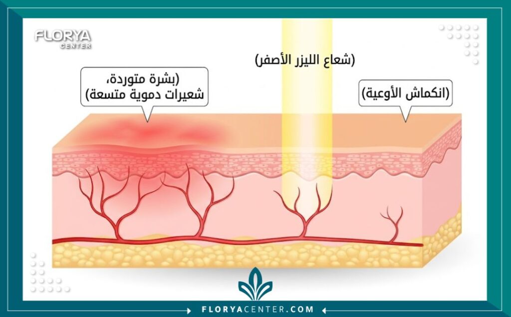 رسم تخطيطي طبي يوضح كيف يستهدف الليزر الأصفر الأوعية الدموية المتسعة لعلاج الوردية واحمرار الجلد.