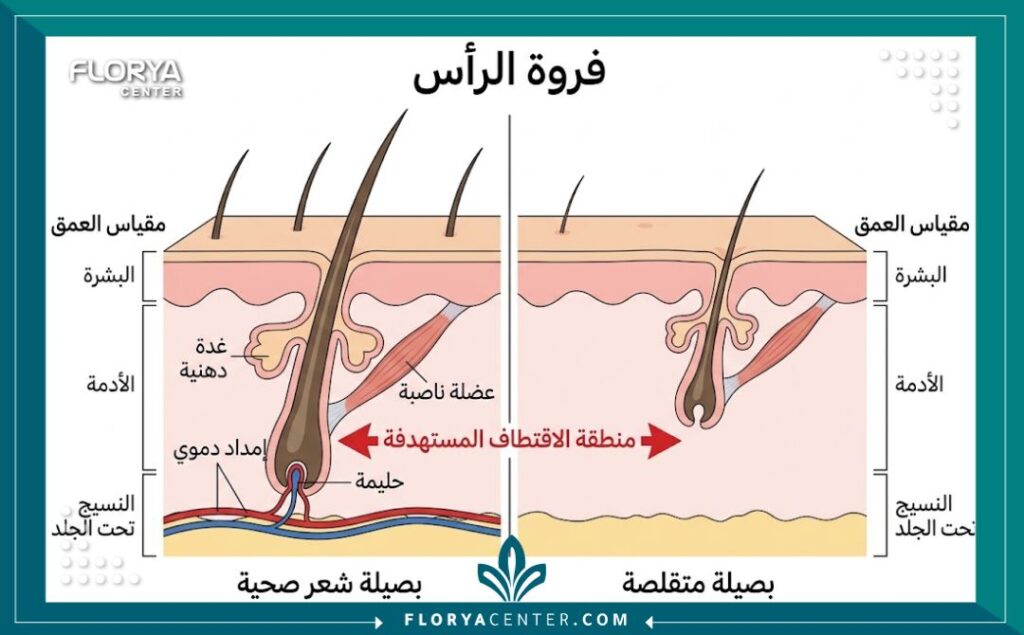 رسم تخطيطي طبي يوضح تشريح فروة الرأس والفرق بين البصيلات الصحية والمتقلصة كما يُرى في المعاينة.