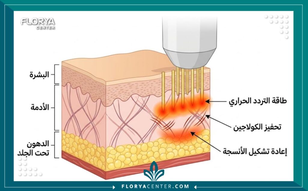 رسم توضيحي طبي يوضح كيفية عمل إبر المورفيوس 8 لشد الجلد من الداخل في تركيا.