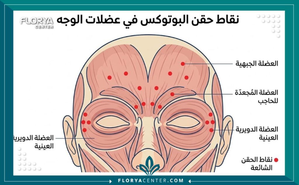 رسم تخطيطي طبي يوضح عضلات الوجه ونقاط حقن البوتوكس الشائعة لعلاج التجاعيد التعبيرية.