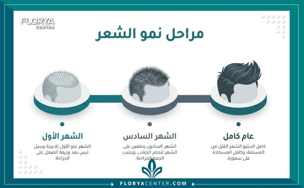 إنفوجرافيك يوضح جدول زمني لنتائج زراعة الشعر وتطور نمو البصيلات خلال عام.