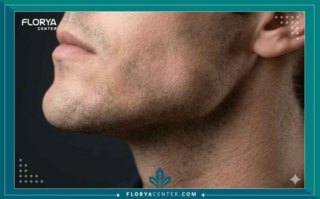 لقطة مقربة تبرز تفاصيل الفك المنحوت والمحدد للرجل بعد إجراء تقنية تكساس بالفيلر.