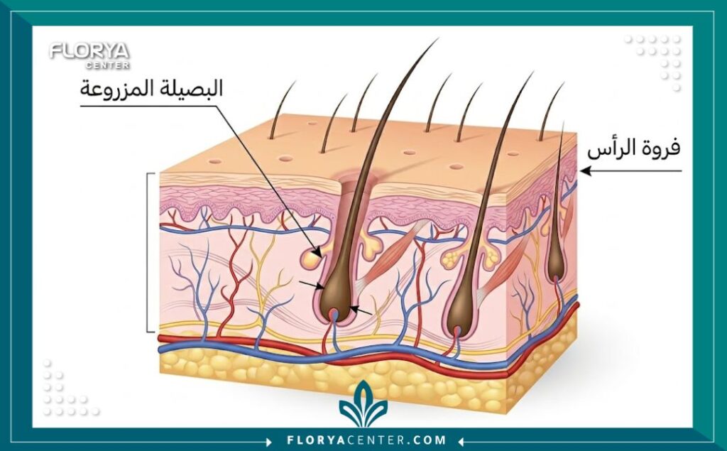 مخطط توضيحي لكيفية تثبيت البصيلات في الجلد بعد عملية زراعة الشعر.