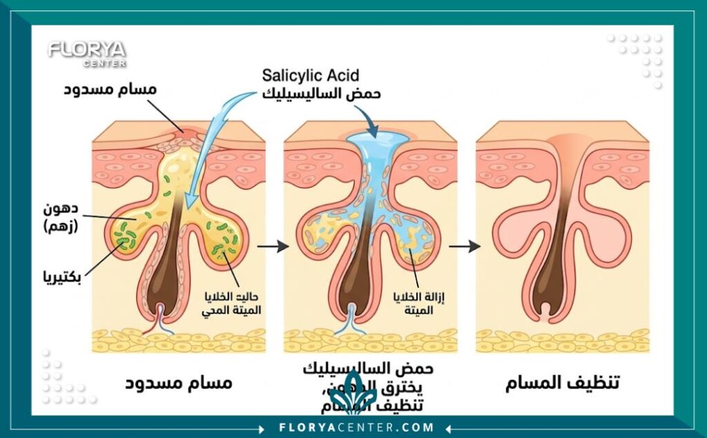 رسم توضيحي طبي يوضح كيفية اختراق حمض الساليسيليك (BHA) للدهون وتنظيف المسام المسدودة بعمق لعلاج حب الشباب.