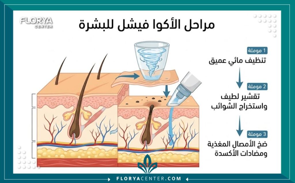 رسم توضيحي طبي يوضح مراحل تنظيف وتقشير الجلد باستخدام تقنية الأكوا فيشل على طبقات البشرة.