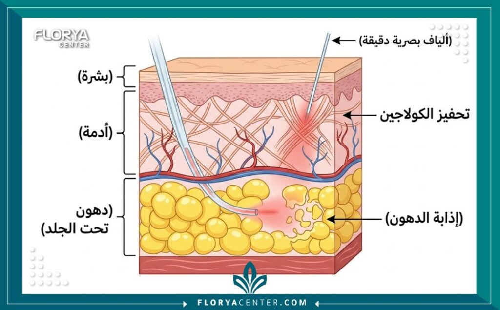 رسم تخطيطي طبي يوضح كيفية عمل ألياف الاندولفت البصرية داخل طبقات الجلد لإذابة الدهون وتحفيز الكولاجين لشد الوجه بدون جراحة.