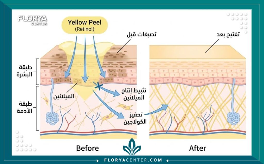 مخطط طبي يوضح تأثير التقشير الأصفر (الريتينول) على طبقات الجلد لعلاج التصبغات وتفتيح البشرة من الداخل.