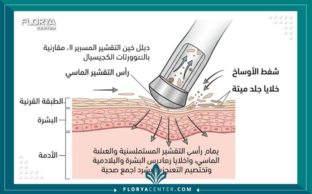 رسم توضيحي طبي يوضح كيفية عمل رأس التقشير الماسي في إزالة طبقة الجلد الميتة دون خدوش.