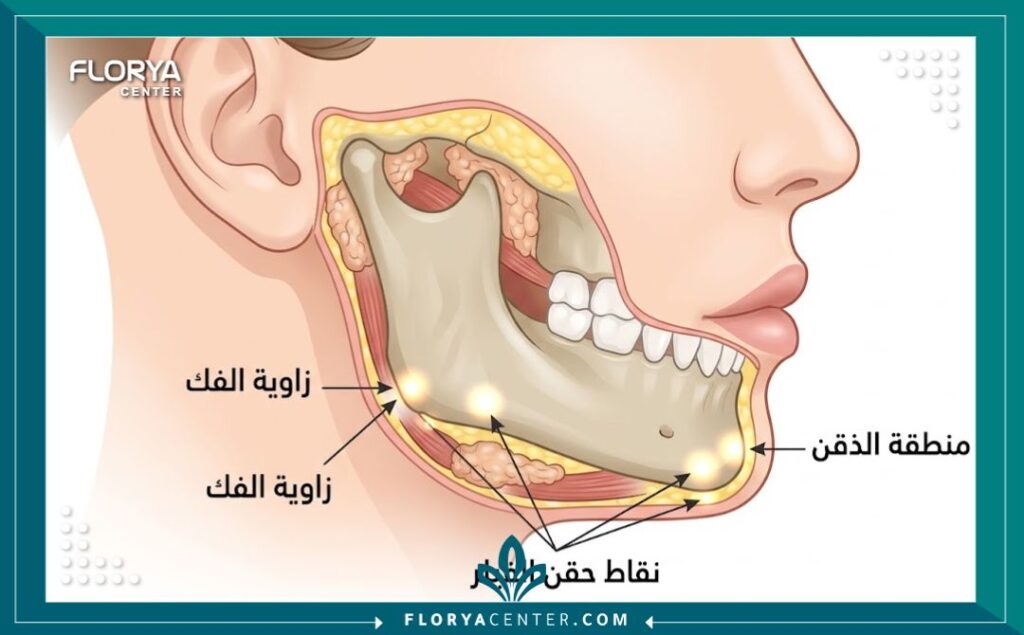 مخطط طبي يوضح مناطق حقن فيلر التكساس لتعريض وتحديد الفك السفلي.