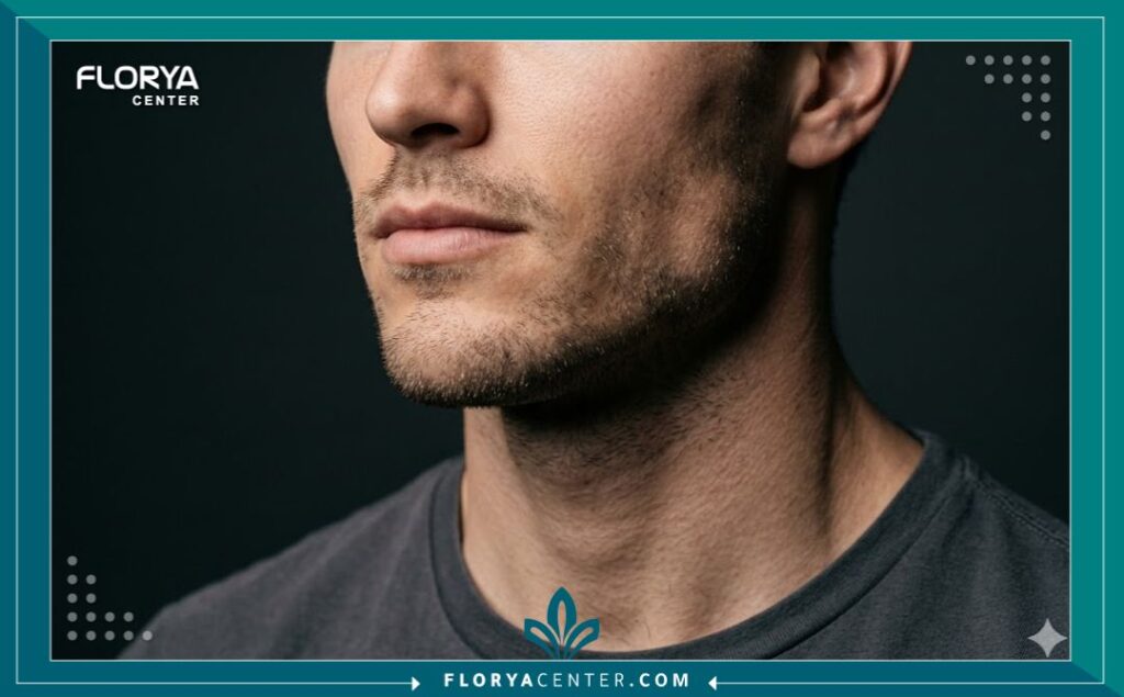 مظهر فك ذكوري عريض ومحدد (لوك التكساس) بعد حقن الفيلر التجميلي.