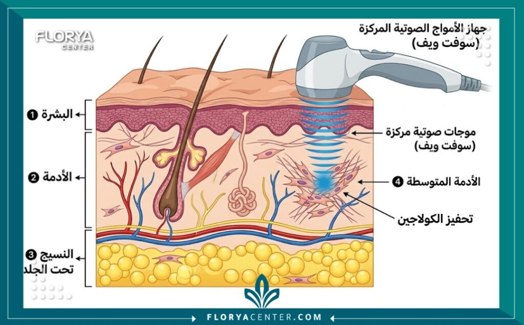 مخطط طبي يوضح كيفية اختراق الموجات الصوتية لتقنية السوفت ويف لطبقة الأدمة لتحفيز الكولاجين لشد الجلد بدون جراحة.