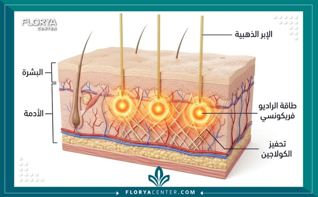 رسم تخطيطي طبي يوضح كيفية اختراق الإبر الذهبية لجهاز الفيفاتشي لطبقات الجلد وتوصيل طاقة الراديو فريكونسي لتحفيز الكولاجين.