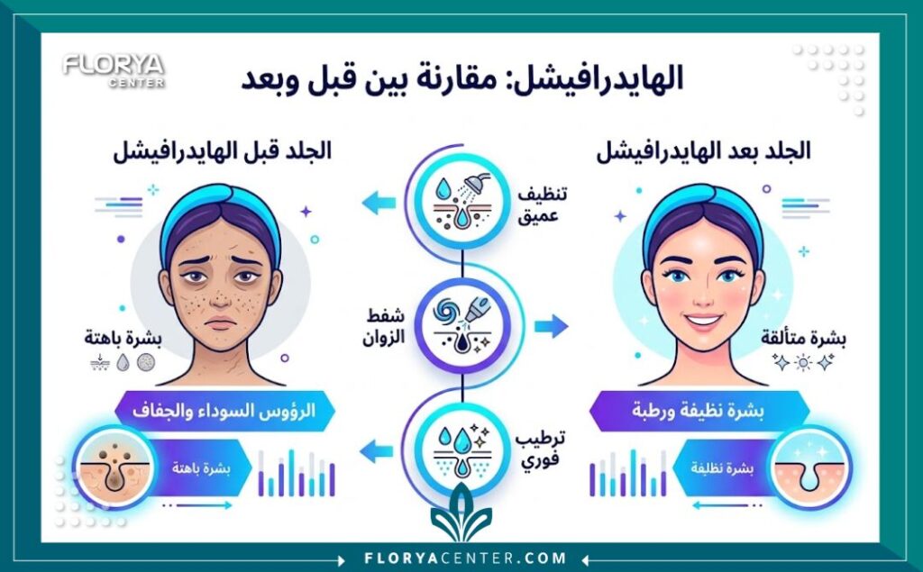 إنفوجرافيك يوضح فوائد تقنية الهيدرافيشل في تركيا: مقارنة بين البشرة قبل وبعد العلاج من حيث النظافة والترطيب واللمعان.