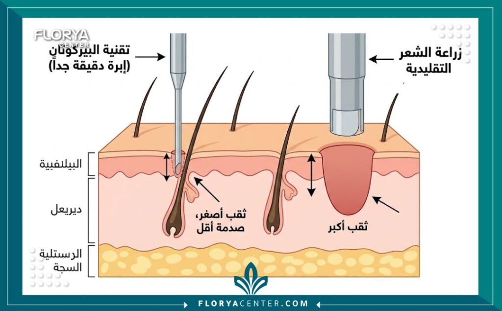تقنية زراعة الشعر البيركوتان 2 رسم تخطيطي طبي يوضح مقارنة بين تقنية زراعة الشعر البيركوتان الدقيقة وزراعة الشعر التقليدية، موضحاً استخدام الإبرة الأسطوانية لتجنب الندبات.