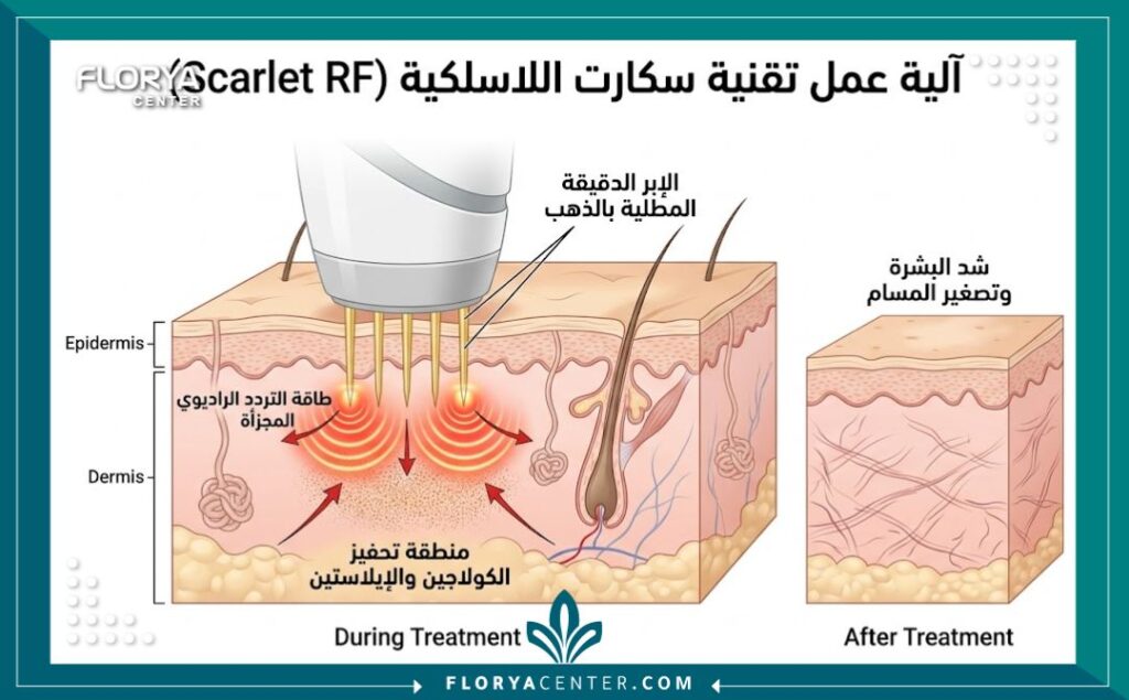 مخطط توضيحي طبي يظهر آلية عمل إبر السكارليت الدقيقة والتردد الراديوي في طبقات الجلد لتحفيز الكولاجين.