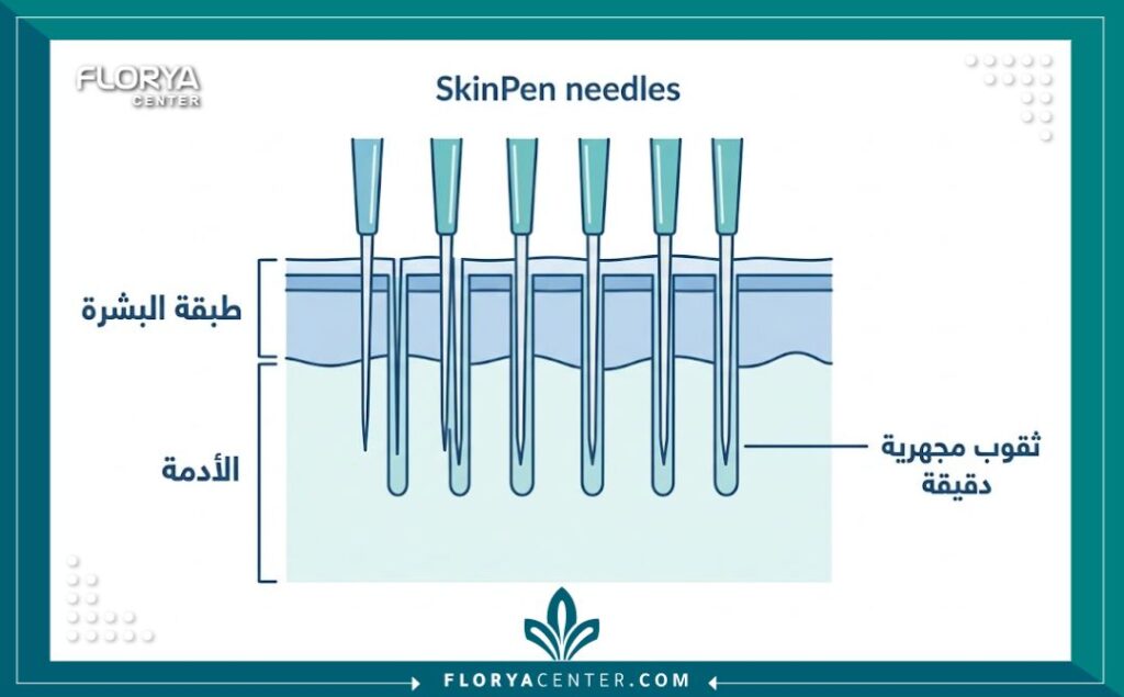 مخطط توضيحي لآلية عمل إبر سكن بن في اختراق طبقات الجلد لتحفيز إنتاج الكولاجين الطبيعي.