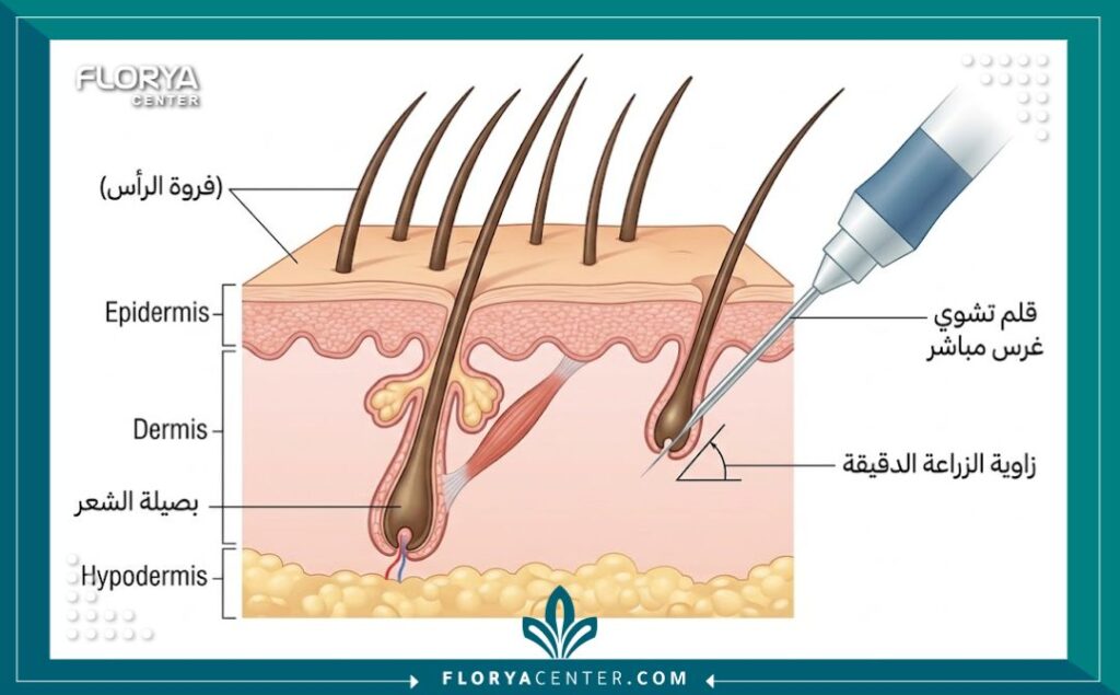 واجهة المقال: رجل ذو مظهر جذاب بشعر كثيف يمسك قلم تشوي المستخدم في زراعة الشعر بتقنية DHI لإظهار النتائج الطبيعية والدقة.
