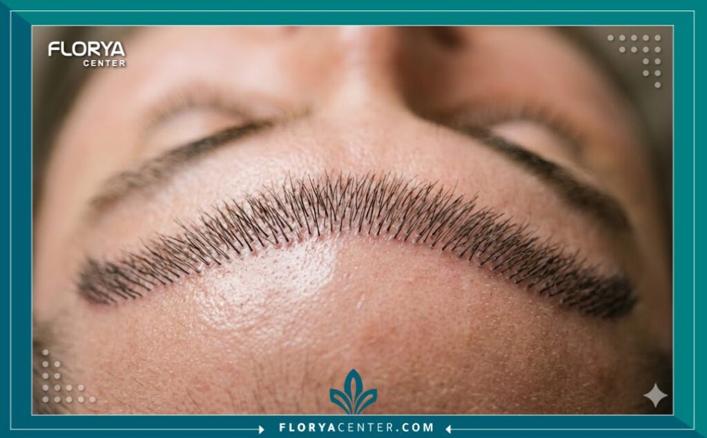 صورة مقربة (ماكرو) لخط الشعر بعد زراعة الشعر بتقنية DHI، تبرز الزاوية والاتجاه الطبيعي الدقيق الذي تضمنه أقلام تشوي.