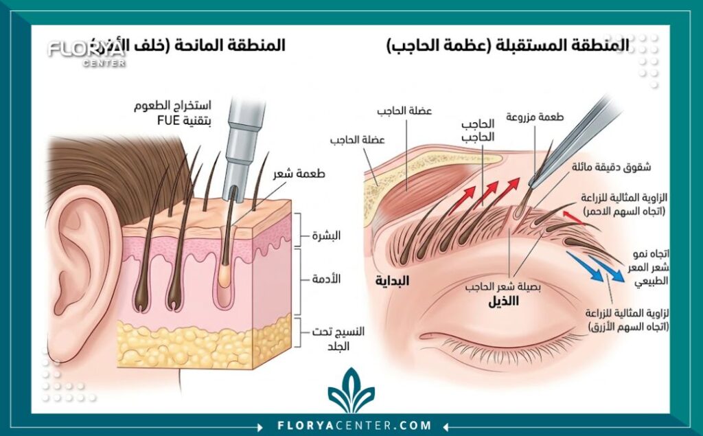 رسم بياني طبي يشرح طريقة زراعة شعر الحواجب بتقنية الاقتطاف ويوضح كيفية تحديد اتجاه نمو الشعرة بدقة.