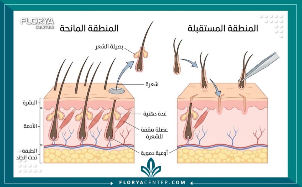 تكلفة عملية زراعة الشعر 2 رسم توضيحي طبي يبين تشريح الجلد ومراحل اقتطاف وزراعة بصيلات الشعر بالتفصيل.