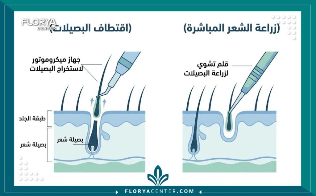 رسم تخطيطي طبي يوضح الفرق بين استخراج البصيلات بتقنية FUE (الميكروموتور) وزراعتها بتقنية DHI (أقلام تشوي) في زراعة الشعر.