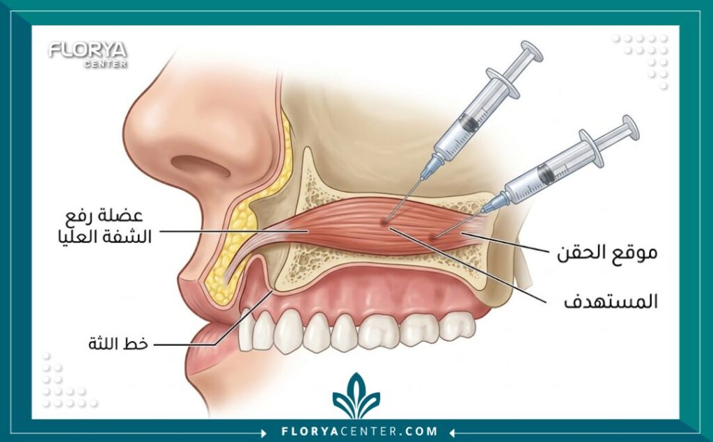رسم تخطيطي طبي يوضح تشريح العضلات ومواقع حقن البوتوكس لعلاج الابتسامة اللثوية.