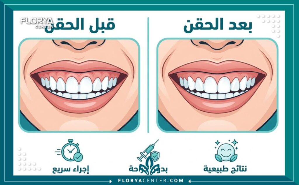انفوجرافيك مقارنة قبل وبعد حقن الابتسامة اللثوية يوضح مميزات العلاج غير الجراحي.