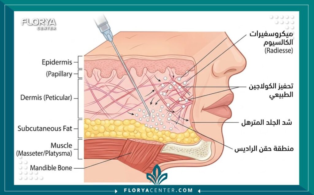 رسم تخطيطي يوضح كيفية عمل فيلر الراديس (الكالسيوم) تحت الجلد لشد الترهلات وتحفيز الكولاجين.