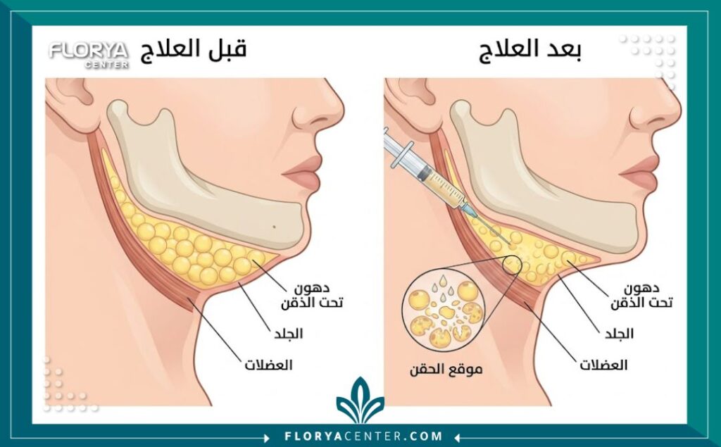 رسم تخطيطي طبي يوضح كيفية عمل إبر تذويب الدهون في منطقة الذقن المزدوج (اللغلوغ).