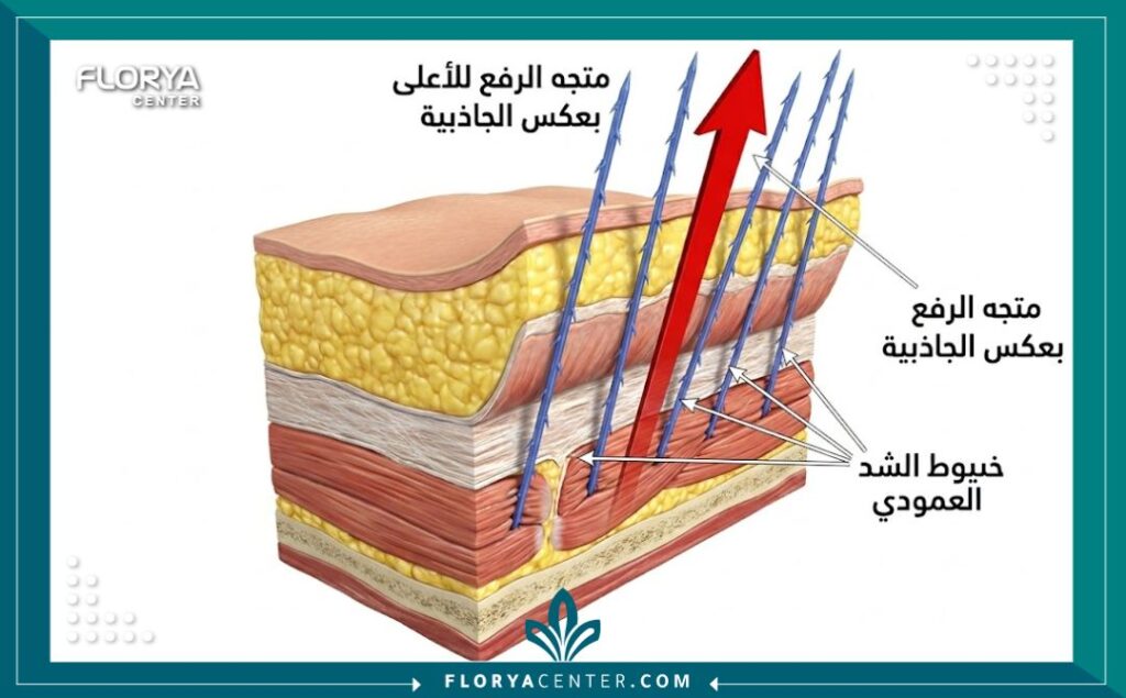 رسم تخطيطي طبي يوضح كيفية عمل خيوط الشد العمودي تحت الجلد لرفع طبقة الـ SMAS والأنسجة المترهلة رأسيًا بعكس اتجاه الجاذبية.