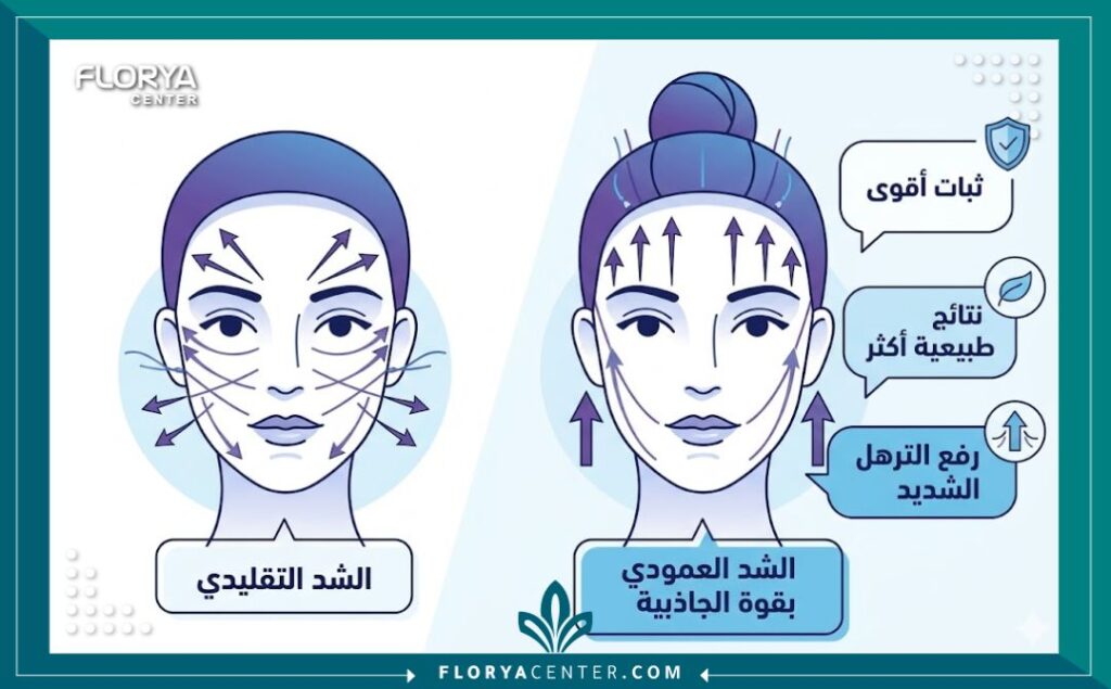 إنفوجرافيك طبي يقارن بين تقنية شد الوجه التقليدية المائلة وخيوط الشد العمودي في تركيا، موضحاً فرق متجه الرفع والنتائج.