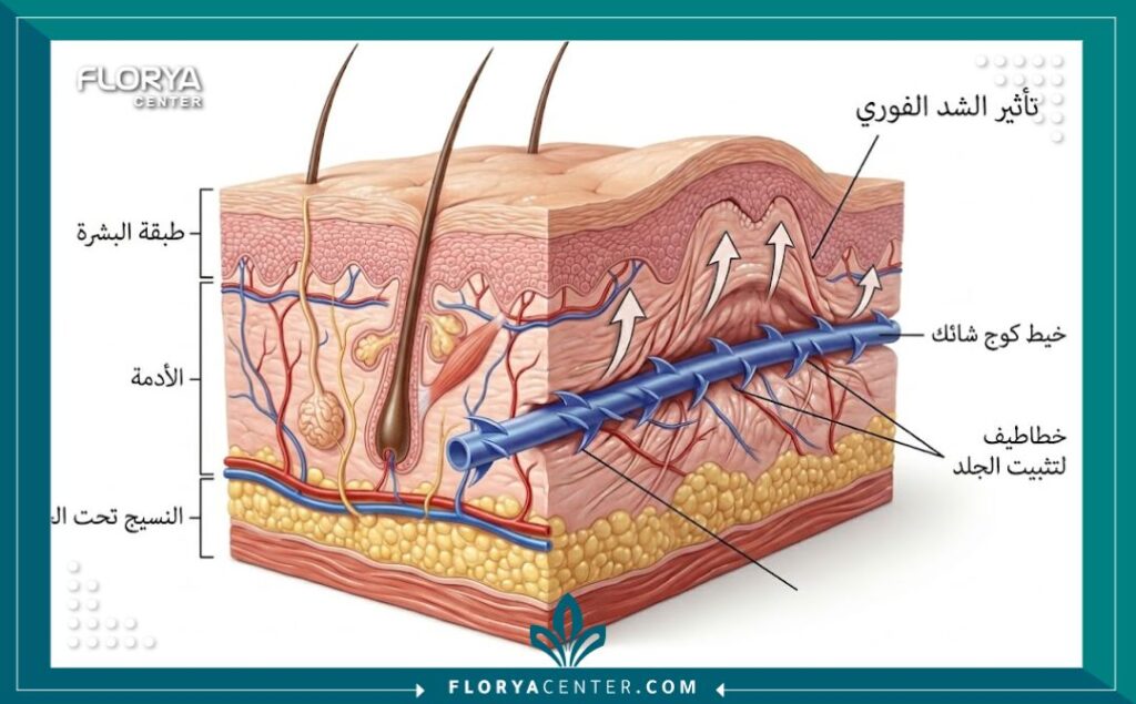رسم تخطيطي طبي يوضح كيفية عمل خطاطيف خيوط الكوج الشائكة في الإمساك بأنسجة الجلد المترهلة ورفعها من الداخل.