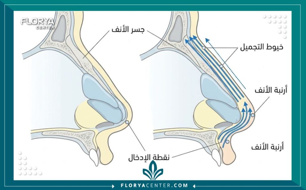 رسم تخطيطي طبي يوضح كيفية عمل خيوط تجميل الأنف في رفع غضاريف الأرنبة.