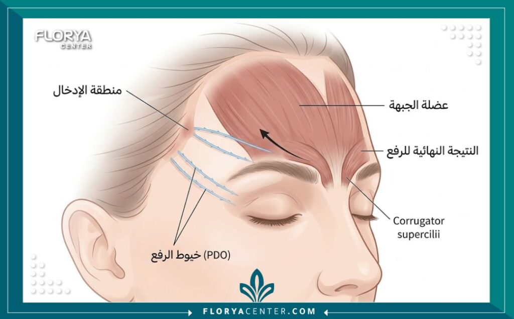 رسم تخطيطي طبي يوضح كيفية عمل خيوط شد الحواجب (PDO) لرفع الجفن المتهدل وزاوية العين الخارجية في التشريح البشري.