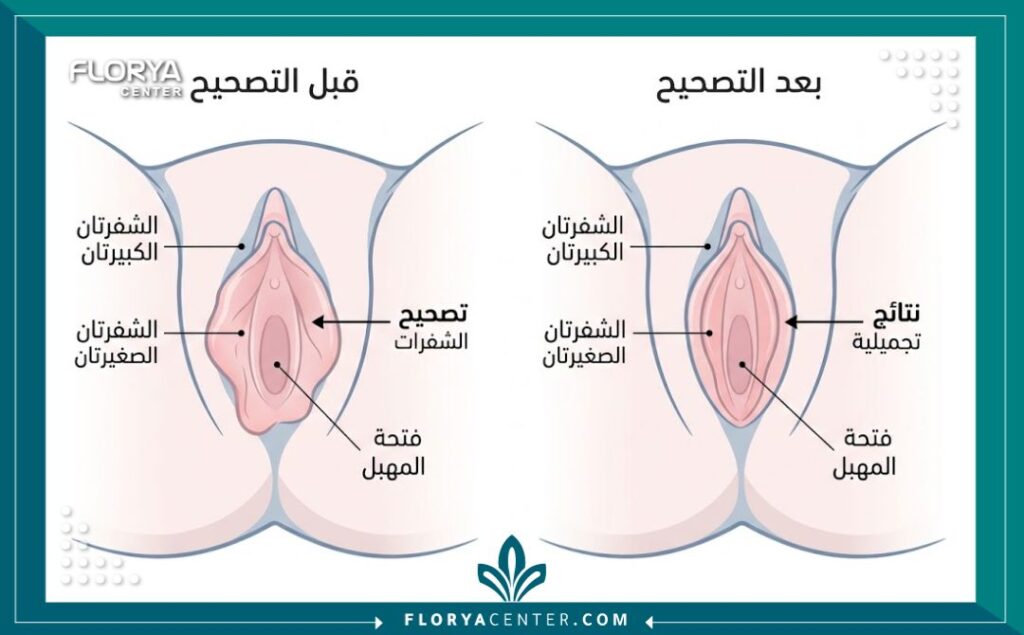 مخطط توضيحي طبي لعملية تجميل وقص الشفرات يوضح المناطق المستهدفة في الجراحة.