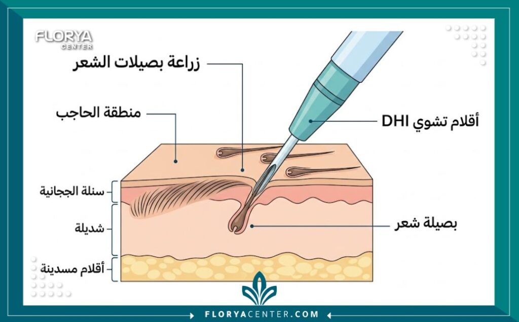 مخطط توضيحي لعملية زراعة شعر الحواجب بتقنية الاقتطاف أو أقلام تشوي
