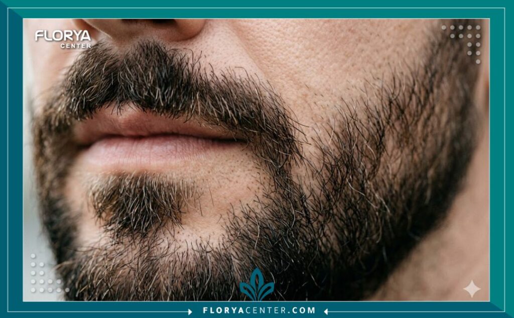 لقطة مكبرة قريبة جدًا (ماكرو) تُظهر كثافة ومظهر طبيعي للشارب واللحية المحددة بدقة بعد عملية زراعة الشارب الناجحة.