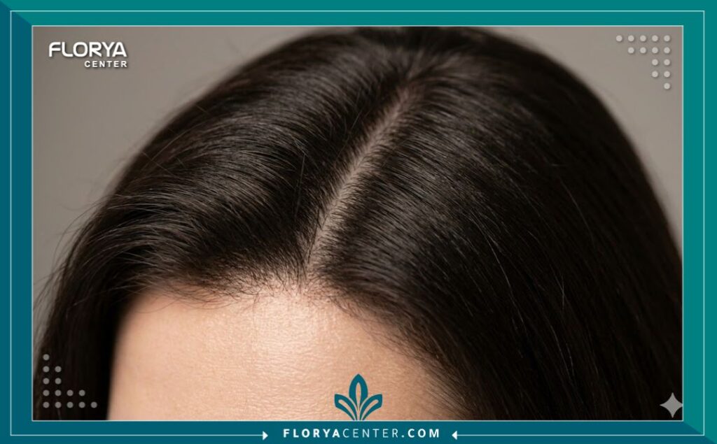 لقطة مقربة تظهر كثافة الشعر الجديدة في مفرق رأس امرأة بعد الخضوع لعملية زراعة الشعر لعلاج الصلع الأنثوي.