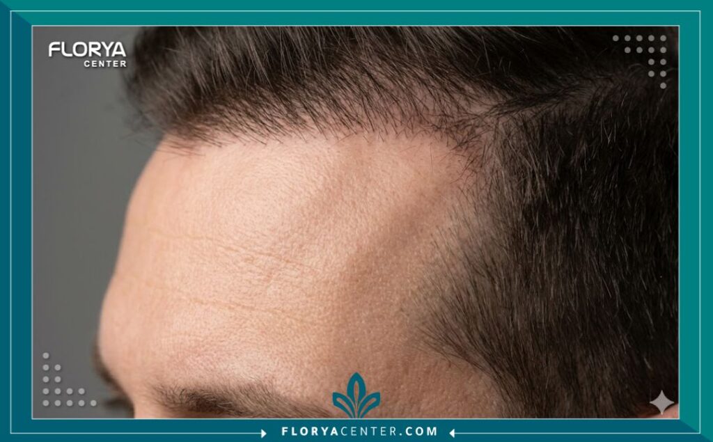 لقطة مكبرة قريبة تظهر تفاصيل خط الشعر الأمامي الطبيعي وتوزيع البصيلات الفردية بدقة بعد إجراء زراعة الشعر بالأسلوب الأمثل لتجنب أي مظهر اصطناعي.