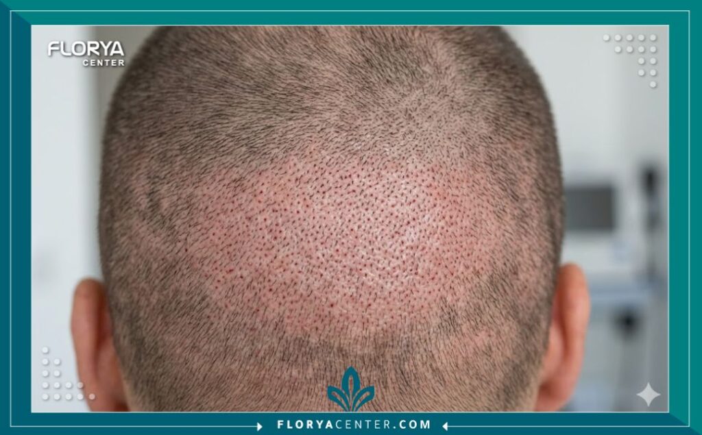 لقطة مكبرة للمنطقة المانحة خلف الرأس مباشرة بعد عملية الاقتطاف الدقيق Nano Fue، تظهر نقاط صغيرة جداً تكاد لا تُرى ولا تترك ندبات.