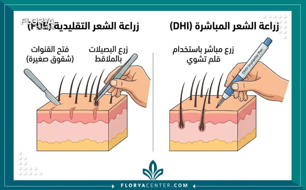 مخطط توضيحي يقارن بين تقنية اقتطاف وحدة البصيلات Traditional FUE وتقنية زراعة الشعر المباشرة DHI، موضحاً الفرق في فتح القنوات والزرع المباشر بأقلام تشوي.