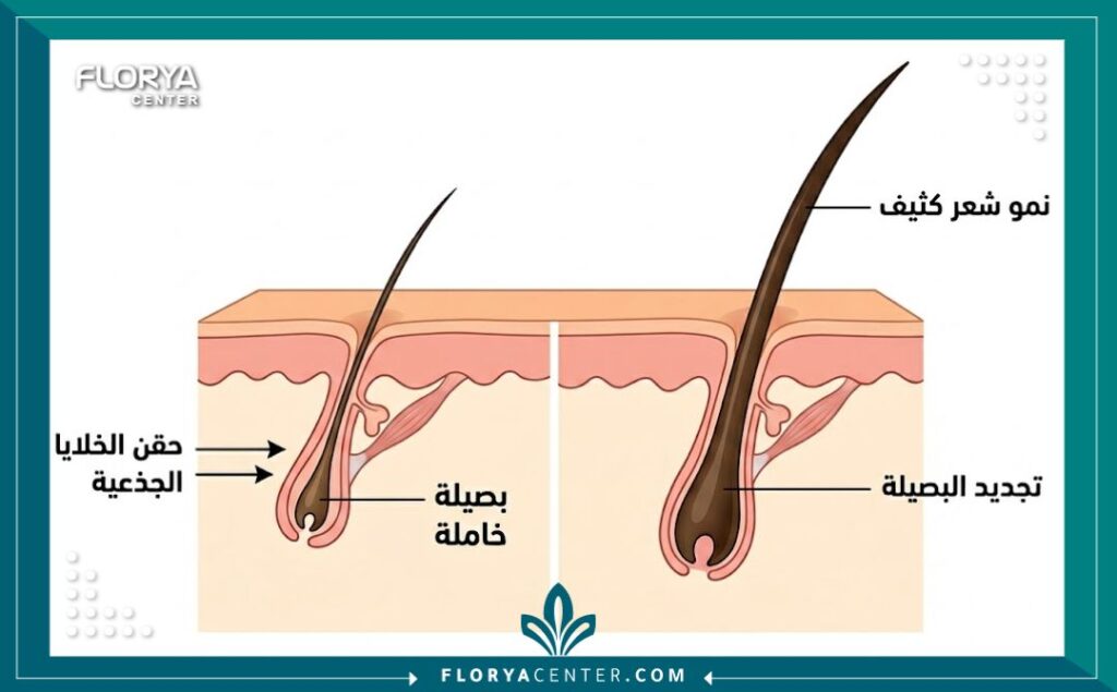 رسم تخطيطي طبي يوضح كيفية تأثير حقن الخلايا الجذعية على تنشيط بصيلات الشعر الخاملة وزيادة كثافتها.