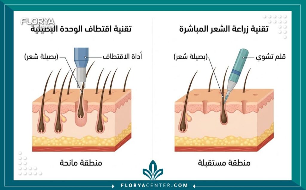 رسم تخطيطي طبي يوضح الفرق بين تقنية الاقتطاف FUE وتقنية أقلام تشوي DHI في زراعة الشعر.